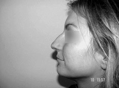 operacja nosa - korekta nosa