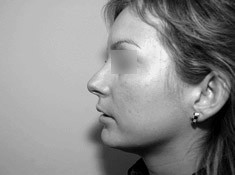 operacja plastyczna nosa - korekta nosa